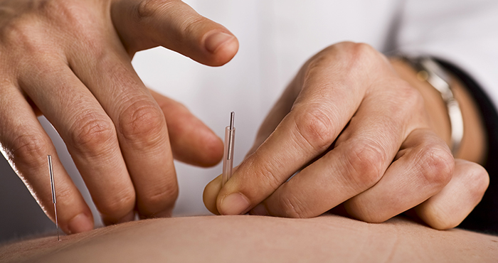 Acupuncturist prepares to tap needle into patients hand